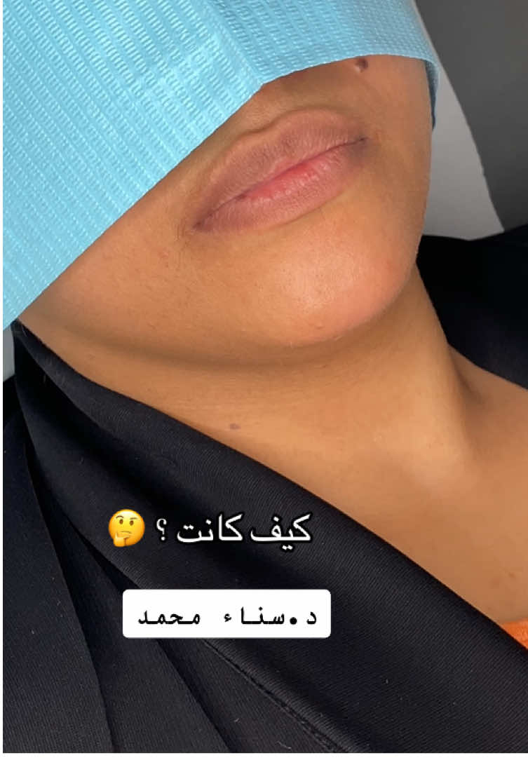 حقن فلر شفايف د.سناء محمد #فلر #بوتوكس #الرياض #مركز_ميلان_الطبي #تجميل 