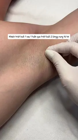 Ngày thứ 9 đến 21 lông sẽ tự rụng kh yên tâm nhé #mayspa #triệt_lông_lạnh_hà_nôi #triệt_lông_lạnh_có_phòng_riêng #triệt_lông_bi #triệt_lông_nách #triệt_đường_viền_chân_tóc 