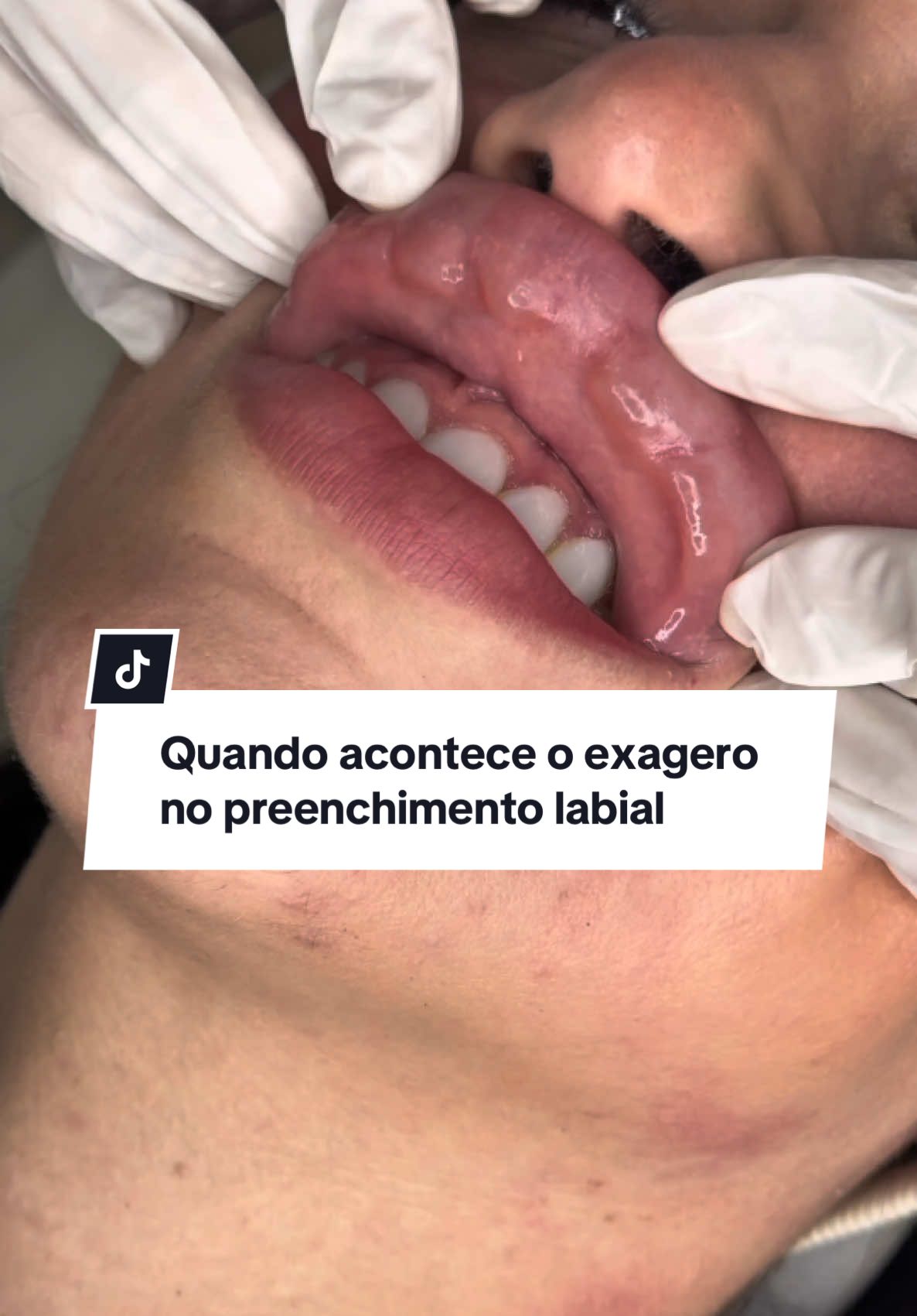 Você sabe identificar quando um preenchimento labial passou do ponto? Nesse caso, além do excesso de produto no contorno, o preenchimento invadiu a região do buço, causando um aspecto artificial e pesado. Preenchimento labial não é só volume. É sobre respeitar a anatomia, manter a naturalidade e valorizar a beleza única de cada rosto. Aqui eu fiz a retirada do excesso e, depois, realizei um novo preenchimento, reposicionando o produto da forma correta — devolvendo harmonia e leveza ao sorriso. Se você sente que seu preenchimento ficou pesado, sem contorno definido ou com aquele volume estranho no buço, procure um profissional capacitado para avaliar. A harmonização certa transforma. A errada, esconde. Gostou do resultado? Comenta aqui! E se conhece alguém que precisa ver isso, marca nos comentários! #harmonizacaofacial #preenchimentolabial #antesedepois #harmonizacaonatural #preenchimentolabial #labios #hialuronidase #desarmonizaçãofacial 