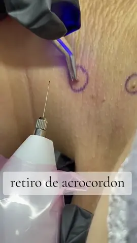 eliminación de acrocordones atravez del dermapen, un tratamiento 100% seguro, no invasivo y sin dolor. agenda tu hora !  @cosmetologa.danaepignac  en instagram  #fibroblast #acrocordones #chile 