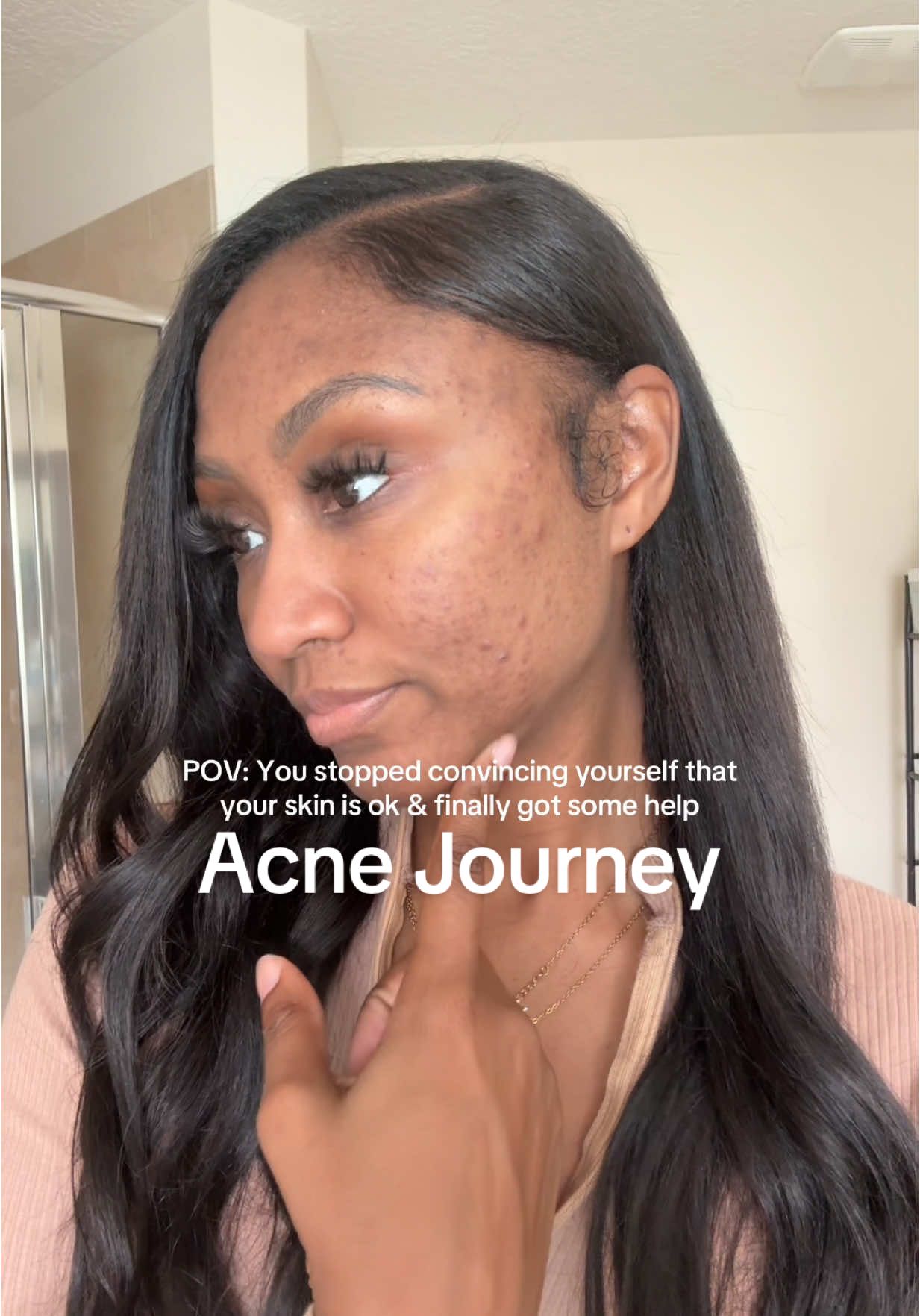 Some skincare routines don't work. Sometimes It's a hormonal thing. I GET IT now🫶🏽 #spironolactone #girlie #tretinoin #dermatologist #pills #medication #acutane #fyp #fy #journey #skincarejourney #storytime #hormonalacne #spironolactonejourney #acne #brownskin #blackgirl #hyperpigmentation #darkspots #oilyskin #combinationskin #dryskin #postinflammatoryhyperpigmentation