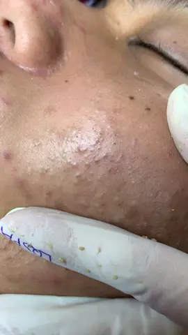 Già cui #chamsocdamun#chamsocdaseo#chamsocdanam#tanbinh#govap #Lequynh #quynhle#lqspa #hocnghespa  #chamsocda #lequynhspa #vienthammylqspa#lqspabeautyacdemy 