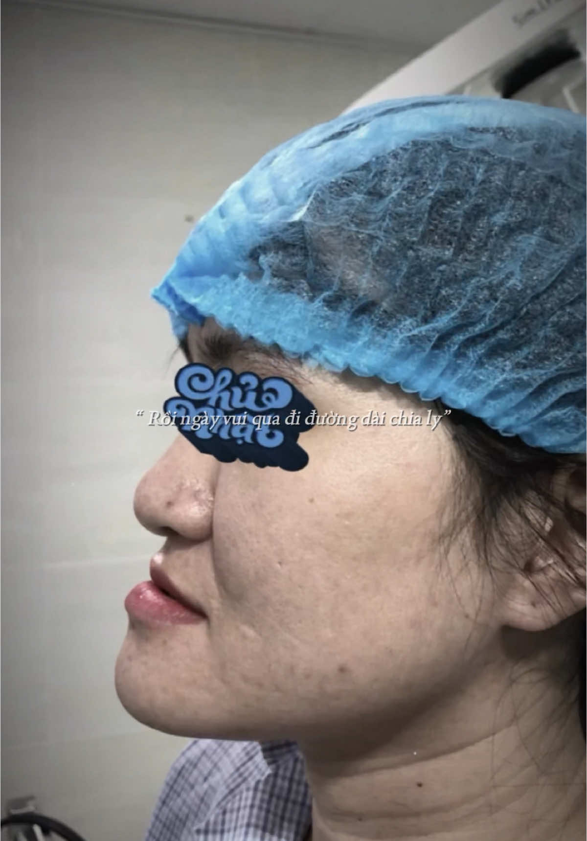 Hành trình phẫu thuật cắt xương hàm móm là một cột mốc lớn trong cuộc đời mình. Từ những năm tháng sống trong sự tự ti vì gương mặt lệch, không dám cười thoải mái, đến khi quyết định bước lên bàn mổ – đó là cả một quá trình đấu tranh và chuẩn bị tinh thần rất dài.  Ca phẫu thuật không chỉ thay đổi diện mạo mà còn thay đổi luôn cả cách mình đối diện với cuộc sống. Dù có đau, có sưng, có những lúc hoang mang, nhưng sau tất cả, mình thấy biết ơn vì đã dũng cảm.  Giờ đây, mỗi lần nhìn vào gương, mình không chỉ thấy một gương mặt hài hòa hơn, mà còn thấy chính mình mạnh mẽ hơn bao giờ hết #changelife #pttm #phauthuathammom 