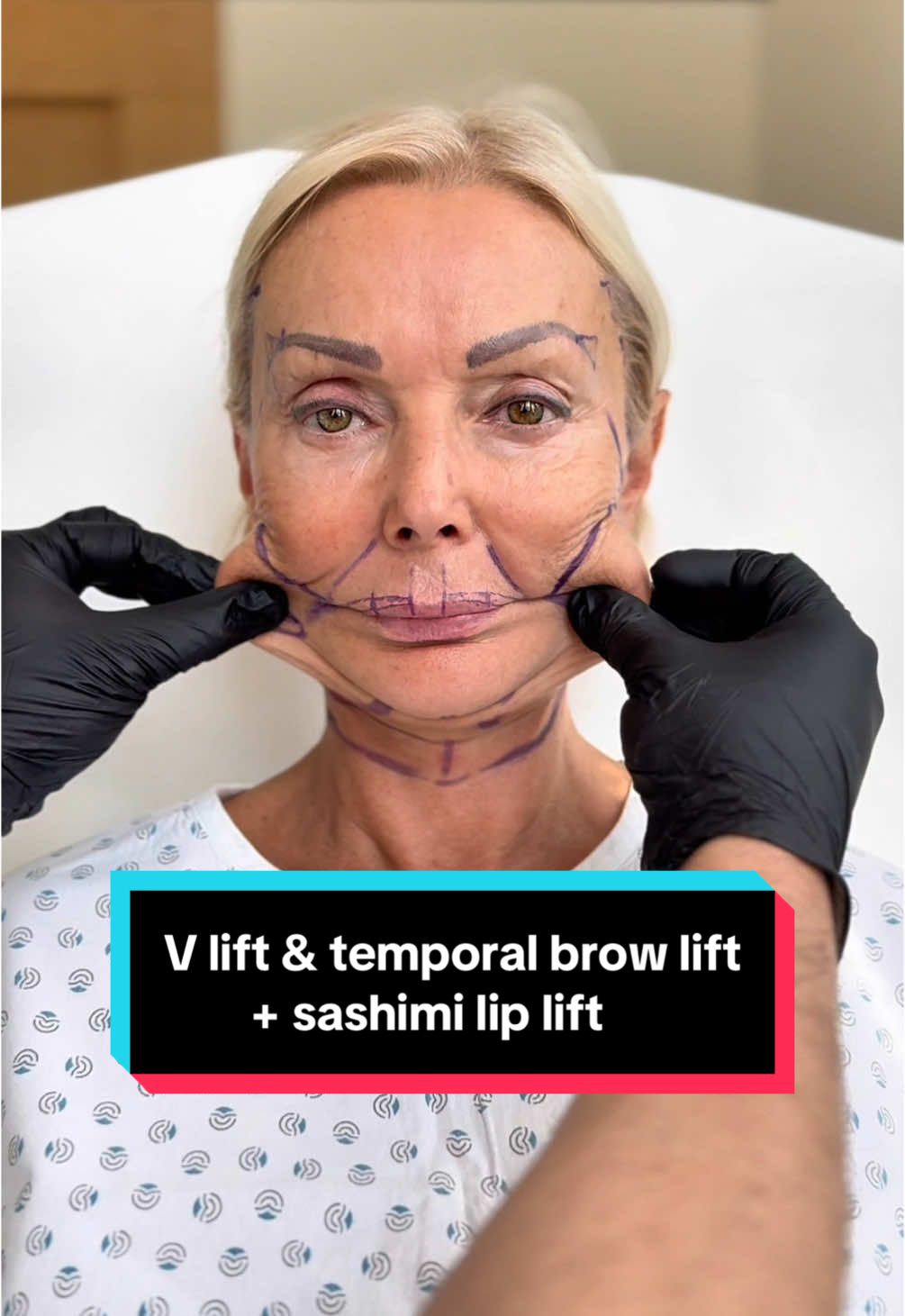 Our beautiful 62 years old patient, right after V lift, temporal brow lift and sashimi lip lift😊 Stay tuned for the final results!👀 All done under local anesthesia💪 📲 If you want to make an appointment, contact us at contact@v-clinic.cz #vlift #temporalbrowlift #browlift #sashimiliplift #facelift #plasticsurgery #ventruba #vclinic 