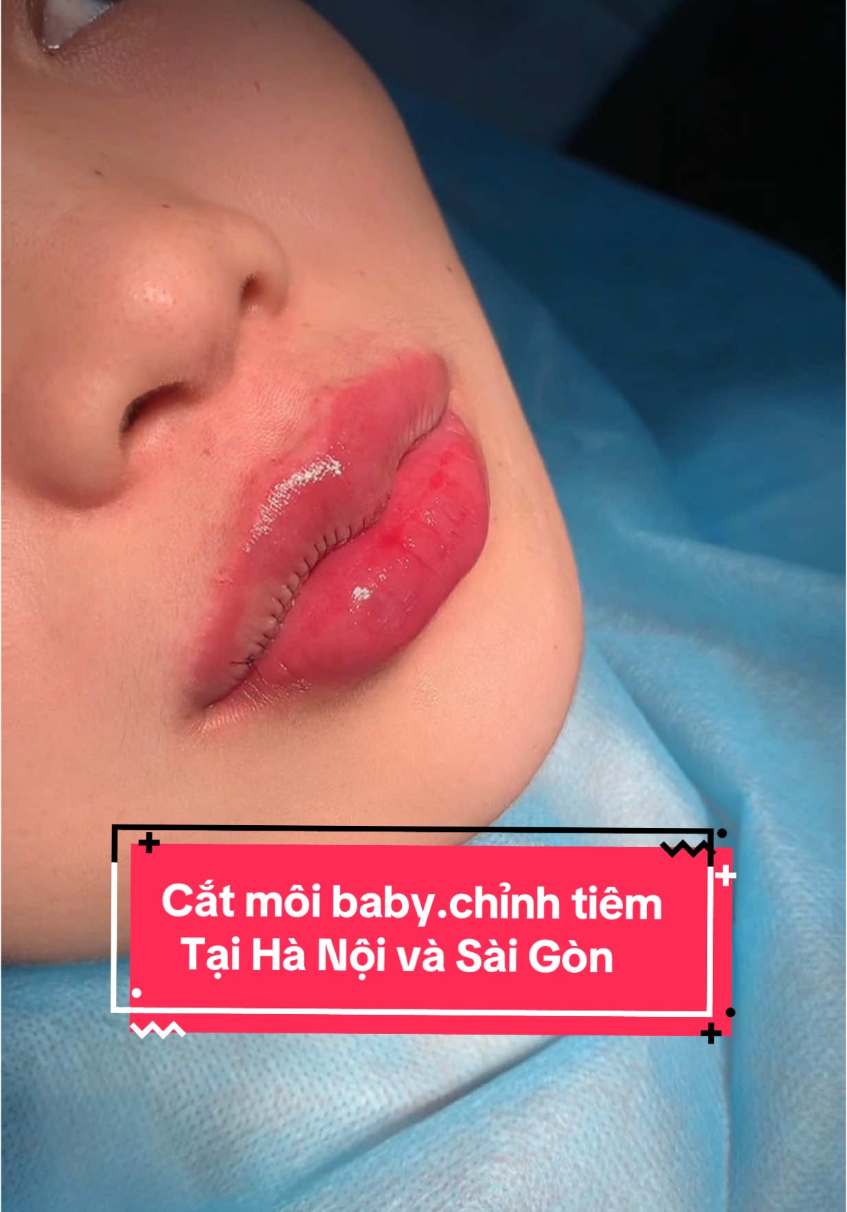 Cắt môi baby#cắtmôitimtựnhiên #cắtminideep #thẩmmycamellia #catmoidep #gaixinh #gaidep 