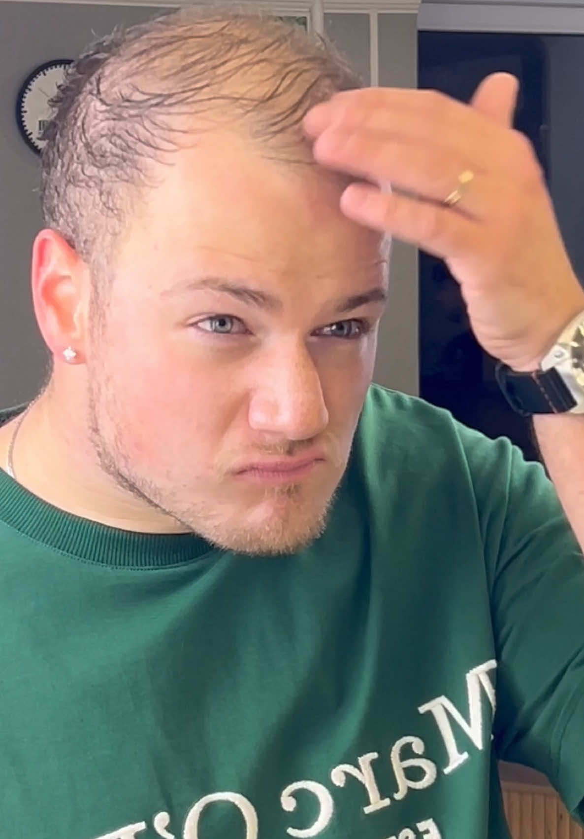Bald & Thinning Hair Transformation  #thickfiber #hairfibres #hairfiber #roottouchupps #hairconcealerpowder 