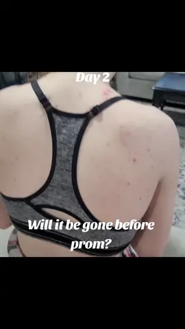 Day 2 of trying Medicube Red Succinic Acid Peeling Pads. Will we be able to get rid of Lilys back acne before prom? This product is supposed to be super great for hormonal acne and what better a test subject than a 16 year old. Follow along and we will document each day's progress and how the product is working! #medicube #hormonalacne #teenacne #bacne #skincare #redsuccinicacid 