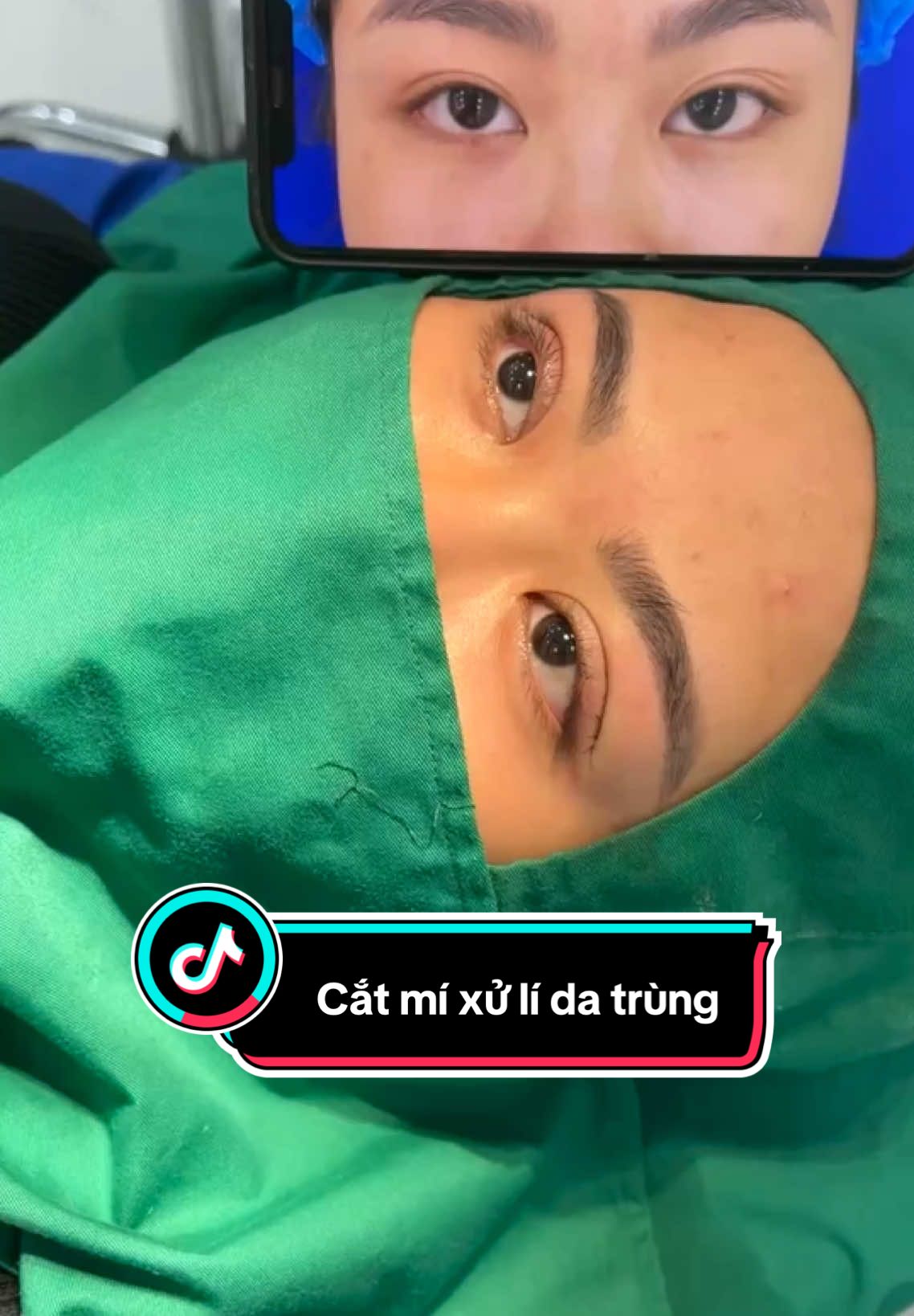 #Cắt Mí Đẹp #PTTM