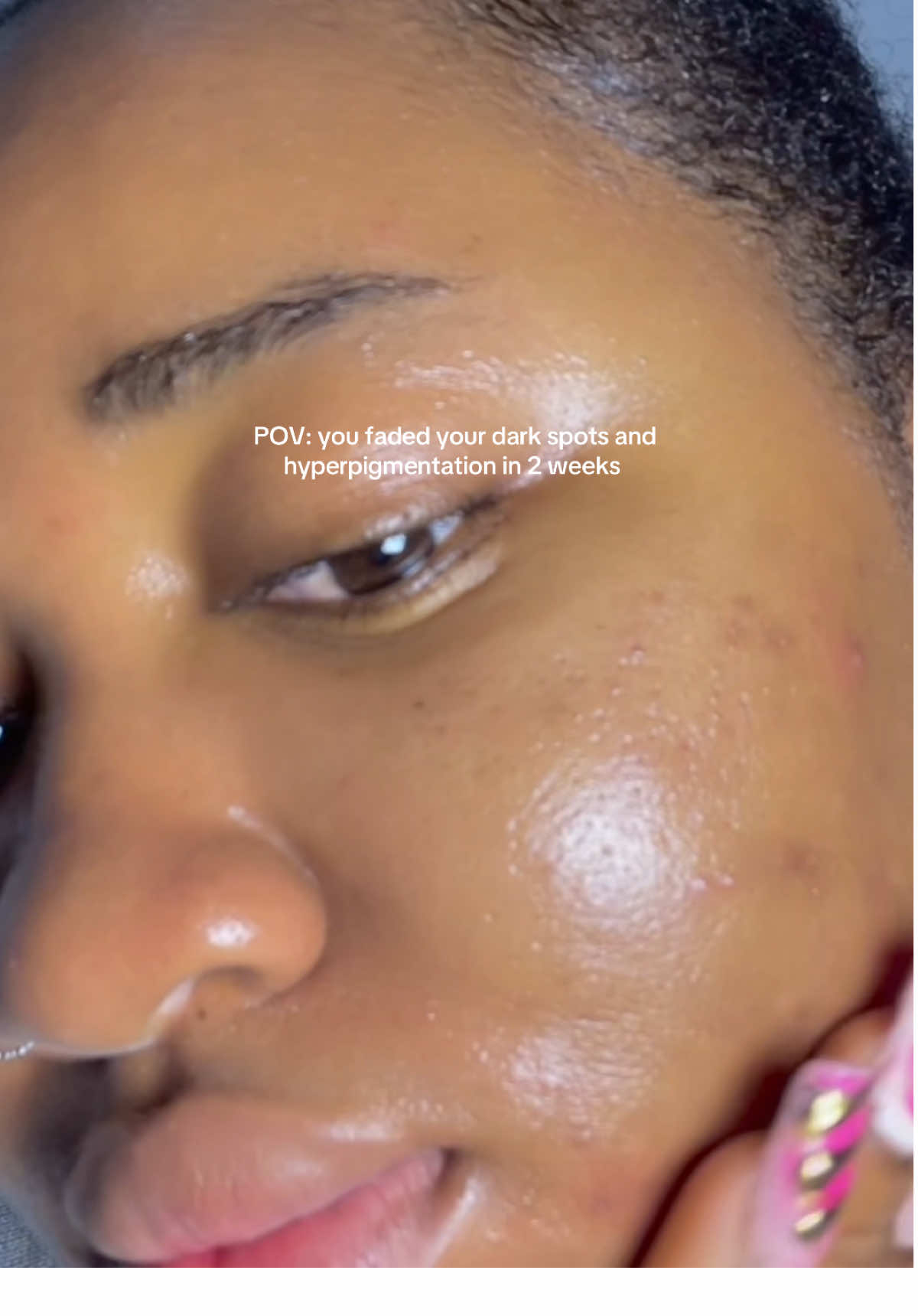 The last video was just this morning and to think I’m on my period, breaking out like mad — but guess what? No dark marks, no hyperpigmentation in sight. This brand? They didn’t come to play at all. We’re showing results! Product: @celimax.global Dark Spot Brightening Serum Would you be trying this product? #skincare #ugccreator #ugc #koreanskincare #kbeauty #skincareroutine #darkspotserum #celimax #celimaxreview #celimaxglobal