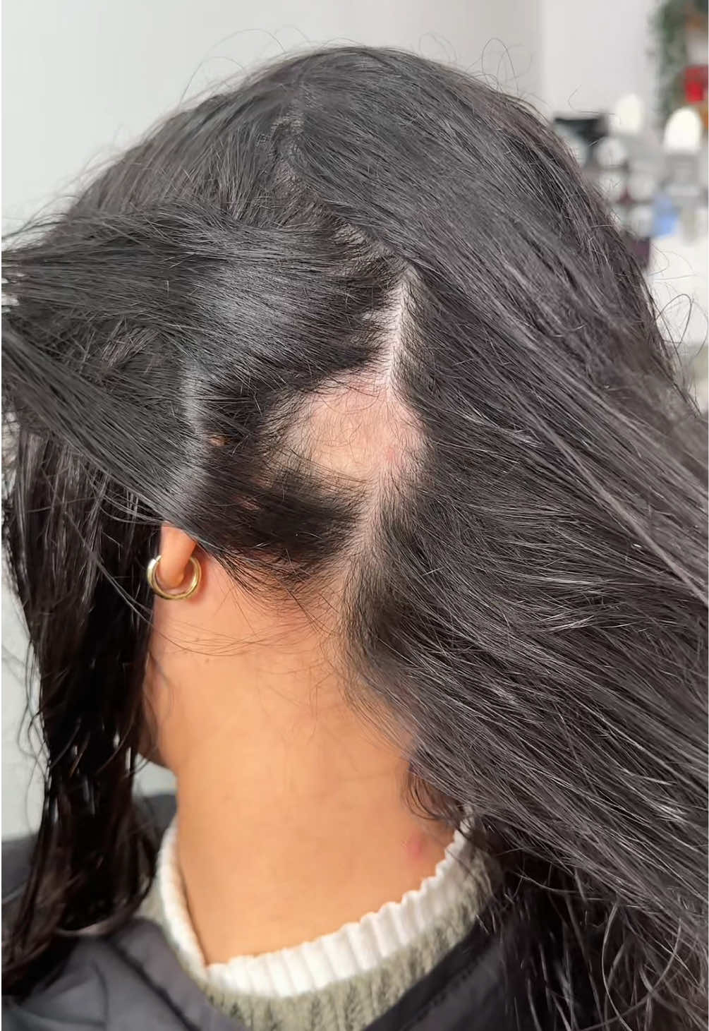 #alopecia #alopeciaareata #alopeciafeminina #quedadecabelo #tratamentoalopecia #dicasportugal 