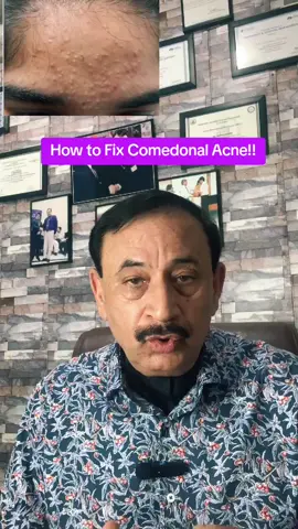 How to fix Comedonal Acne. acne #acnetreatment #acneskin #acnefighter #oilyskin#openpores #comedones#skincare #azeleicacid #retinolskincare #oilyskin #fyp #viral#skincaretipsforyou 
