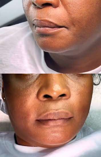 Les sillons nasogéniens peuvent donner un air fatigué ou vieilli. Grâce à l’acide hyaluronique, redonnez de la jeunesse à votre visage en douceur. Nous Sommes situés  📍Deido rue des stars 📞656 16 28 72 #RidesNasogéniennes#AcideHyaluronique#InjectionVisage#MédecineEsthétique#AntiRides#RajeunissementFacial#EmbellissementNaturel#SoinsEsthétiques#VisageHarmonieux#BeautéSansChirurgie#NasolabialFolds#DermalFillers#FacialRejuvenation#YouthfulSkin#NaturalResults#NonSurgicalTreatment#AestheticClinic#