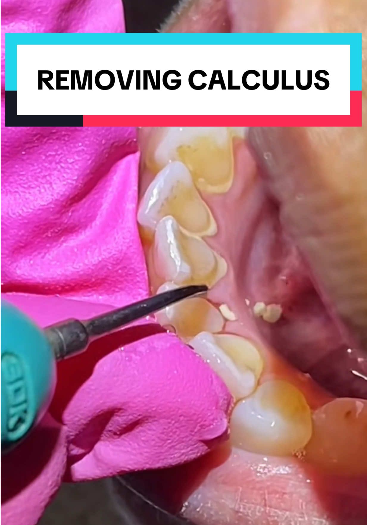 My hygienist thought she would never do calculus in her job 🤧  #dentistsoftiktok #asmr #satisfying #plaque #dentalschool #dentistry #cleaning #cool #onthisday