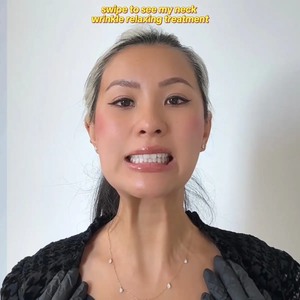 @Velour Medical #botox #neckline #neckwrinkles #necklift #smoothskin #nycinjector #nycbotox 