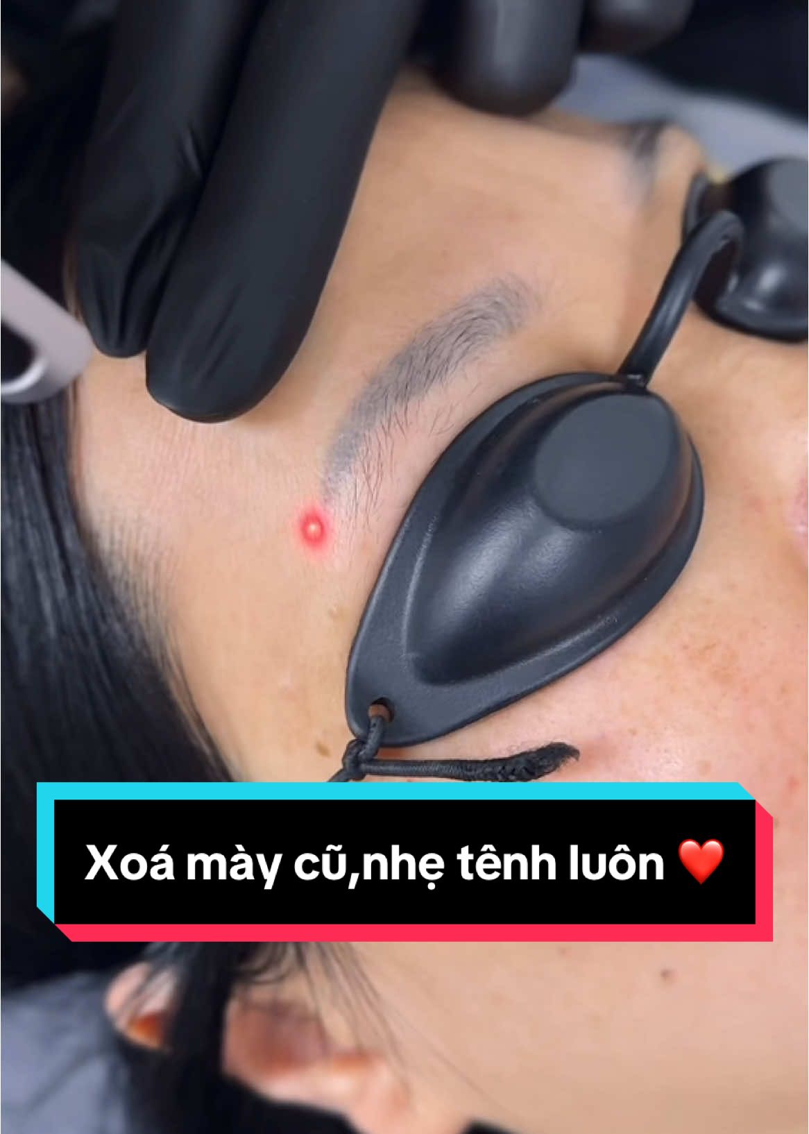 Laser lông mày êm ruuu,nhẹ tênh luôn ạ 😊 #machibeauty #xoá_sửa_chân_mày #phunxamthammy #xoálaser #xoá_xăm 