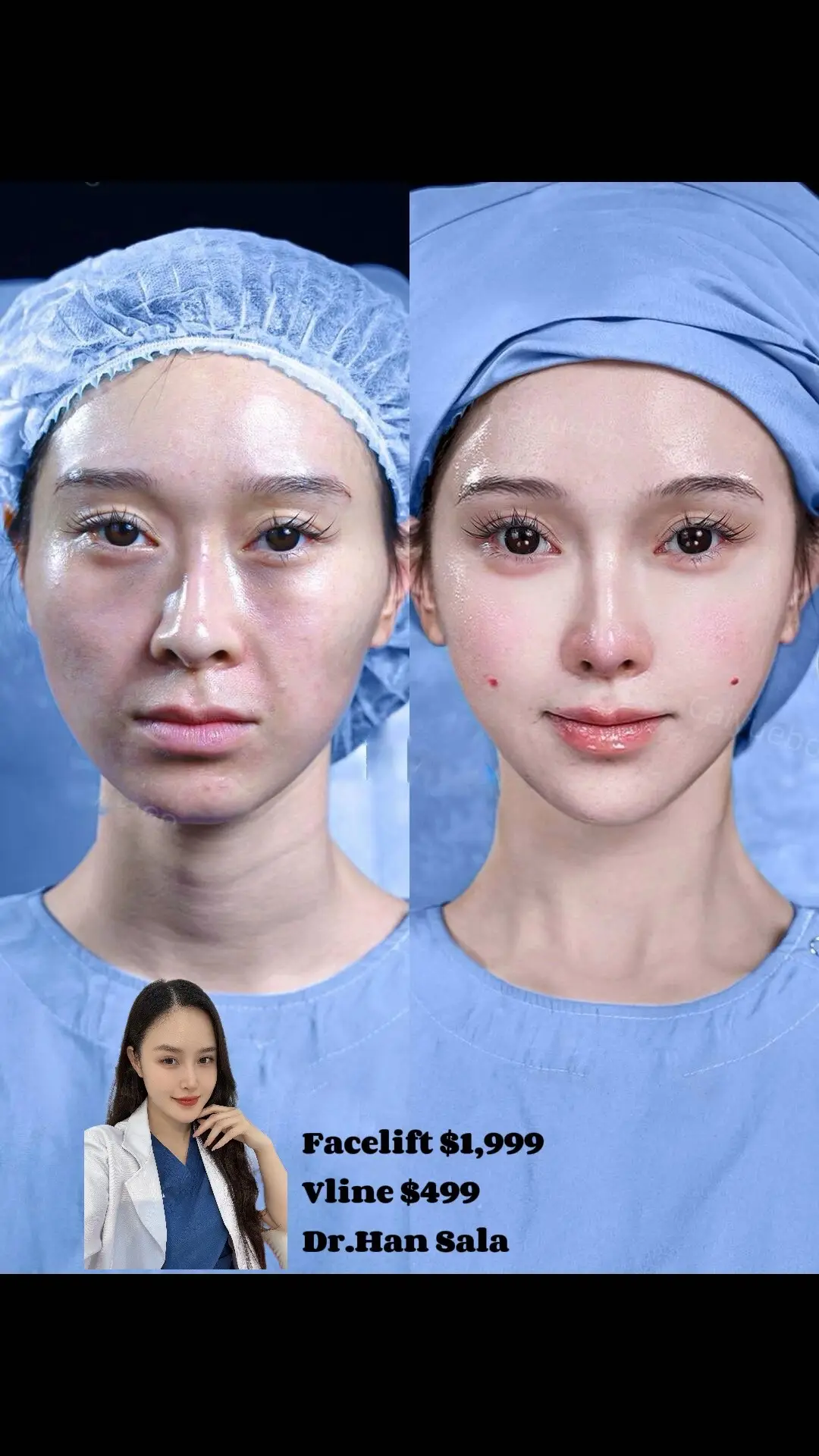 #cosmeticsurgery #viral #drhansala #plasticsurgeonsoftiktok #facelift 