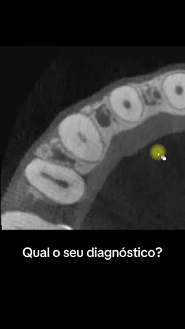 Qual o seu diagnóstico e conduta clínica em um caso como esse? #odontologia #conteudoparadentistas #tomografia #drjulianobueno 