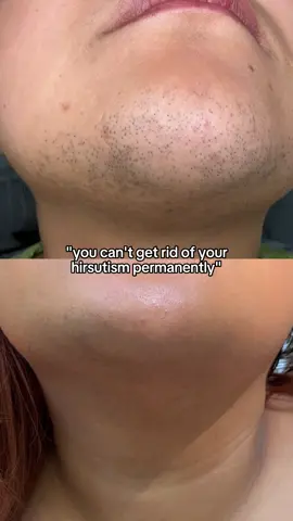 Raise your hand if you're tired of shaving your face 🙋‍♀️ #pcos #pcoshair #hirsutism #hairremovaltips