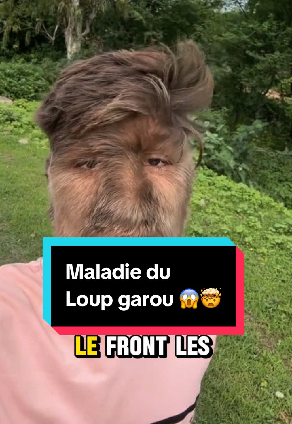 La maladie du loup garou , l’une des maladies les plus rares au monde 😱😱 #maladie #incroyable #loupgarou #guinessworldrecord 