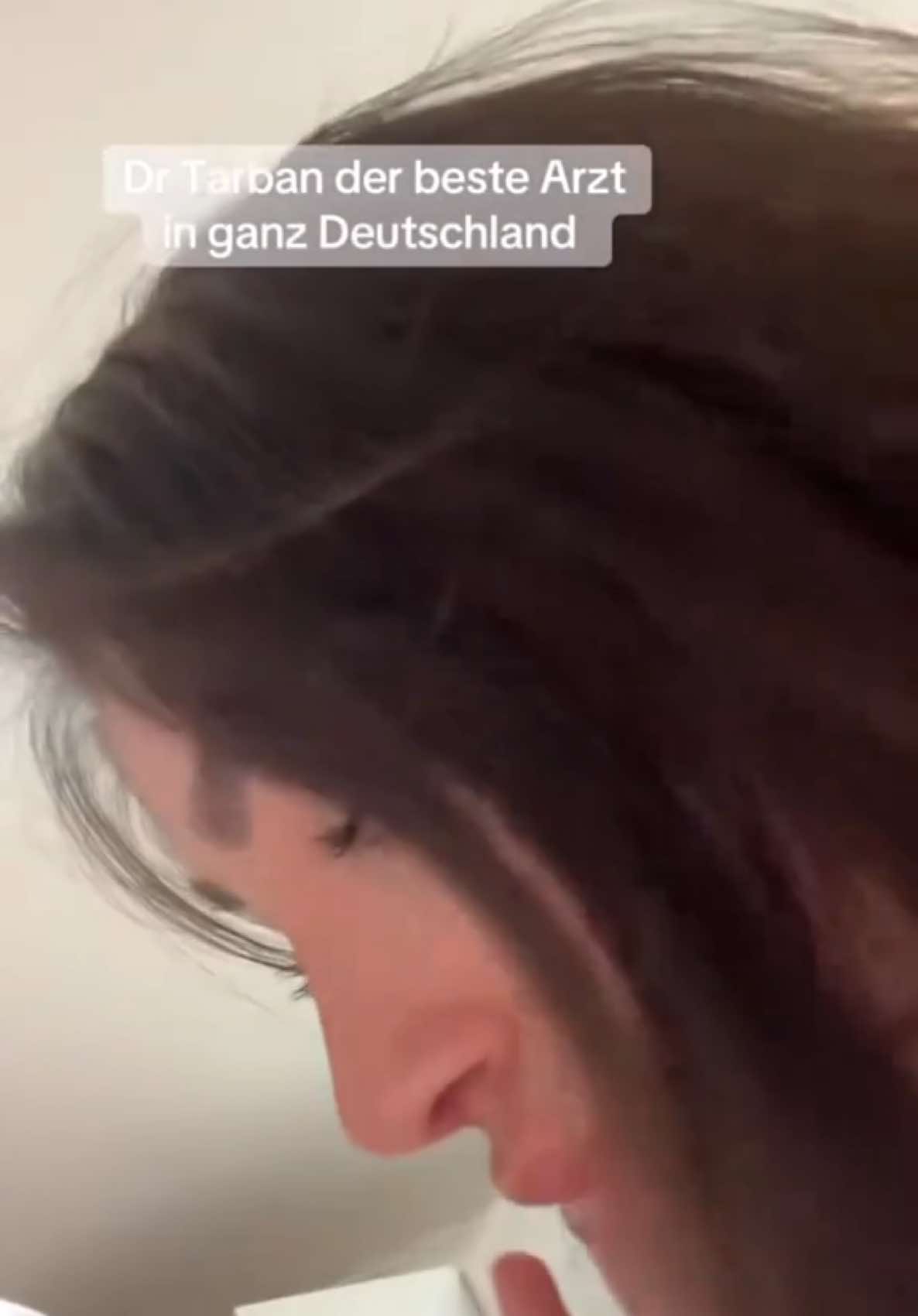 My beautiful patient and her viral post in TikTok. Only 1 months post op. Early result with lot of swelling and still looks amazing 🫶🏻 We can NOT post before videos according Germany rules.  Aus rechtlichen Gründen ist uns das veröffentlichen des Voher-Videos nicht mehr gestattet.  Bei der innovativen Ultrasonic rhinoplasty technique wird der Nasenknoch nicht wie sonst üblich, mit dem Hammer, gebrochen.  Der Nasenknochen wird durch einen feinen Aufsatzes des Ultraschallgeräts „Piezo“ abgetragen und geformt. Dies funktioniert mittels Schallwellen. Mit dieser Methode hat man am Ende der Operation, im Vergleich zur üblichen, kaum Schwellungen, Hämatome und dementsprechenden weniger schmerzen sowie intraoperative Blutungen!  Ultrasonic Rhinoplasty is a technique that nasal bone are not broken. Nasal bone is shaped by cutting with a very fine tip. This device which called piezo work with sound waves. Edema, swelling, and bruising is less common. #rhinoplasty #nosejobdubai  #rhinoplastydubai #nasenoperation#nasenkorrektur #nasenop#Rhinoplasty#rhinoplastybeforeandafter#nosejob #nasenkorrekturdüsseldorf #nasenkorrekturdeutschland#rhinoplastyistanbul #rhinoplastyturkey#تجمیل_الأنف #الانف #تجمیل_الانف 
