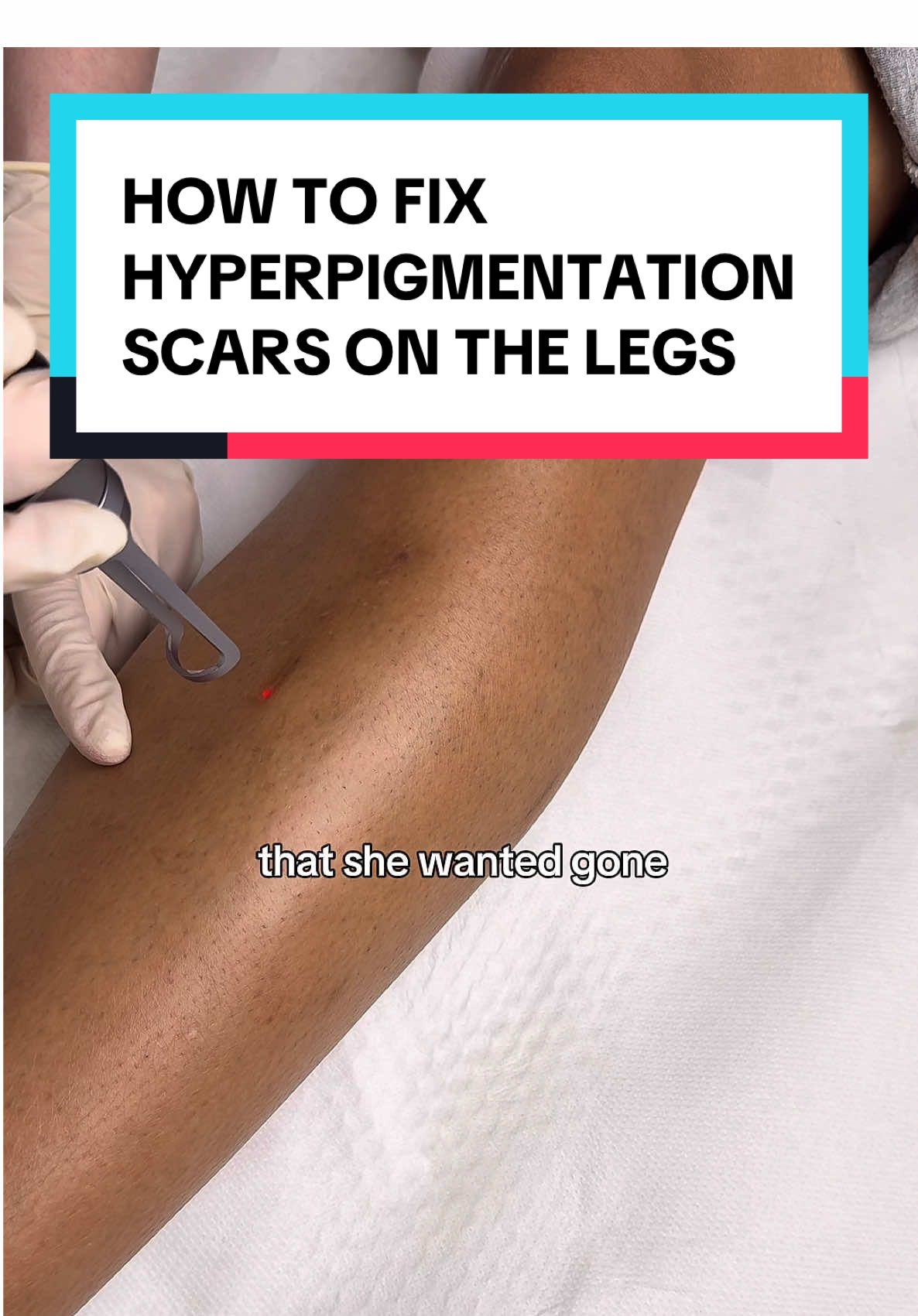 HOW TO FIX HYPERPIGMENTATION ON THE LEGS 🦵🏽😍 Pico laser is one of the most effective treatments for hyperpigmentation on the legs, including dark spots, mosquito bite marks, and post-inflammatory pigmentation. It uses ultra-short laser pulses to shatter unwanted pigment deep within the skin without damaging the surface. This advanced technology also stimulates collagen production, which helps smooth out old scars and improves overall skin texture. Pico laser is safe, non-invasive, and delivers visible results with minimal downtime, making it ideal for treating pigmentation and scarring on the body. #hyperpigmentation #skin #darkskin #blackskin #darkspots #pigmentation #darkmarks #viral #fyp #legs #london #brownskin 