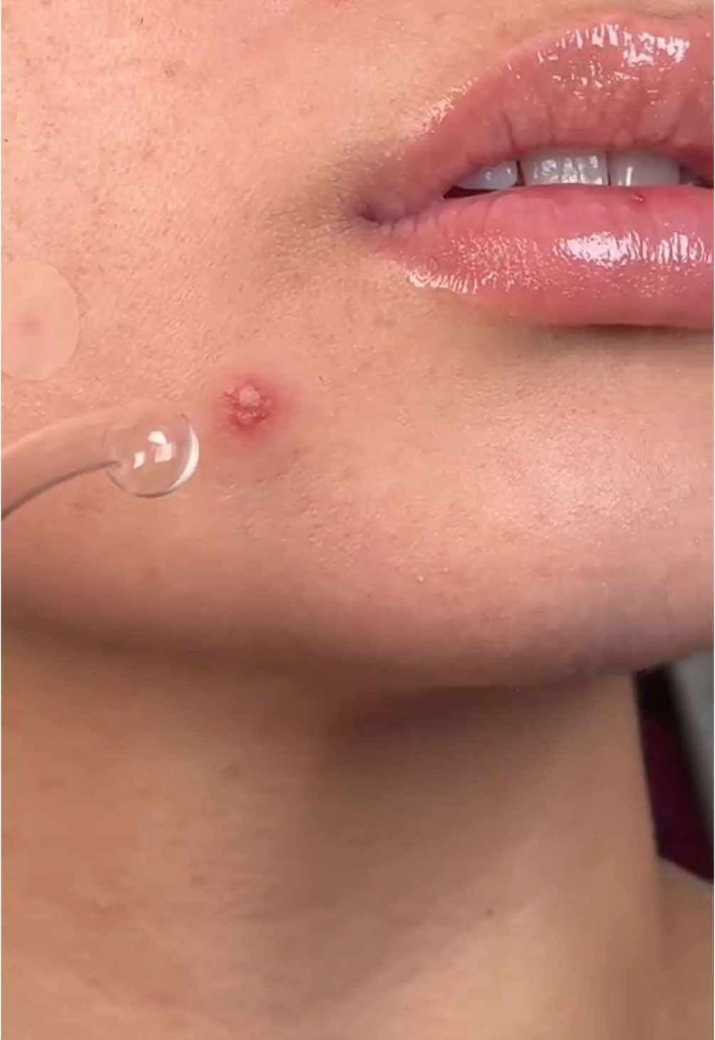 Replying to @LIKA After struggling with this huge pimple for two days, I finally remembered I own a high frequency wand 😅 #pimples #highfrequency #highfrequencywand #breakout #beautytoks #skincare #skintok 