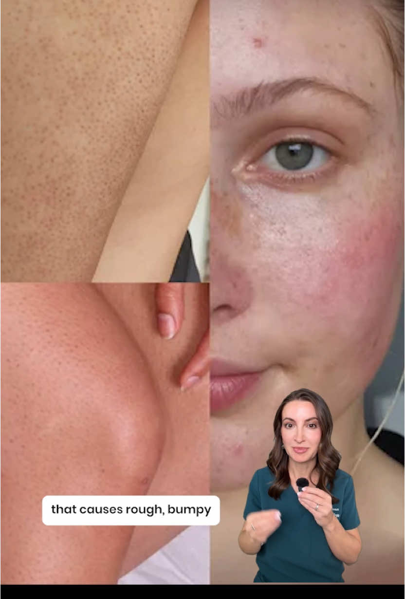 Bumps on your arms or thighs that just won’t go away? 👀 It might be Keratosis Pilaris (aka KP)—a super common skin condition that can be stubborn but manageable with the right routine. ✨ Key steps? Think gentle chemical exfoliation (like lactic, glycolic, or salicylic acid) and daily moisturizing with skin-loving ingredients like urea or ceramides. 🚫 Skip the scrubs—harsh exfoliants can make things worse. 💡 The real secret? Consistency. Results take time, but they do happen! ✨For more info on KP check out my YT channel (linked in bio) Have you ever dealt with KP? What’s helped your skin the most?👇 #KeratosisPilaris #DermTips #SkincareFacts #ExfoliationTips #HealthySkinJourney #glycolicacid #urea