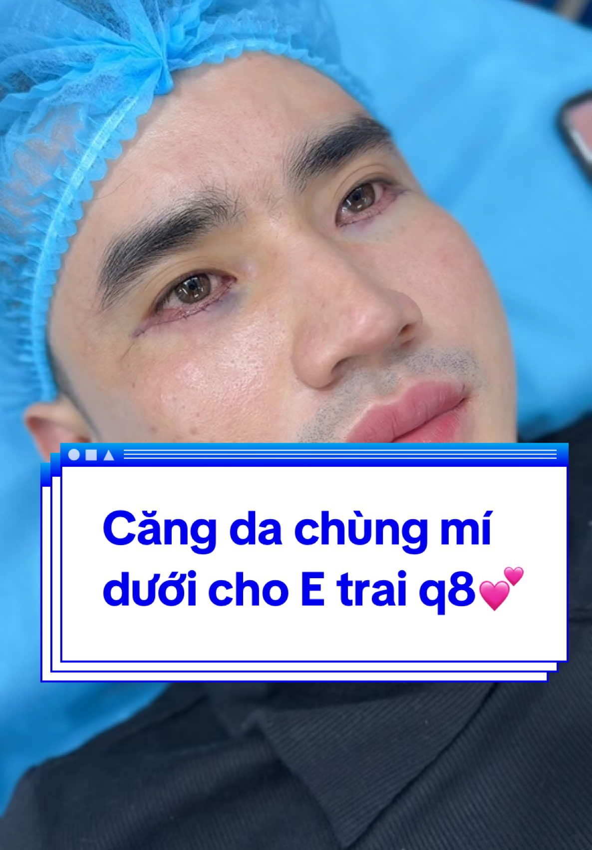 Căng da chùng mí  dưới cho E trai q8💕#Tuyết_Diamond #videoviralitiktok #xuhuong #khâu_rút_chỉ #cắt_mí_dưới_đẹp
