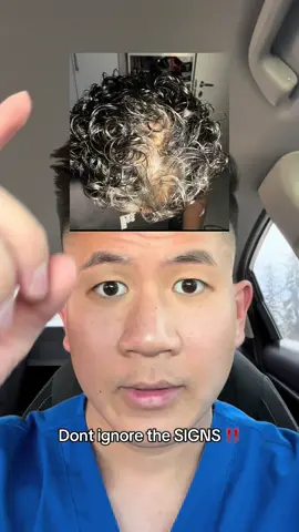 #resultsmayvary #hairthinning #balding #hairloss 