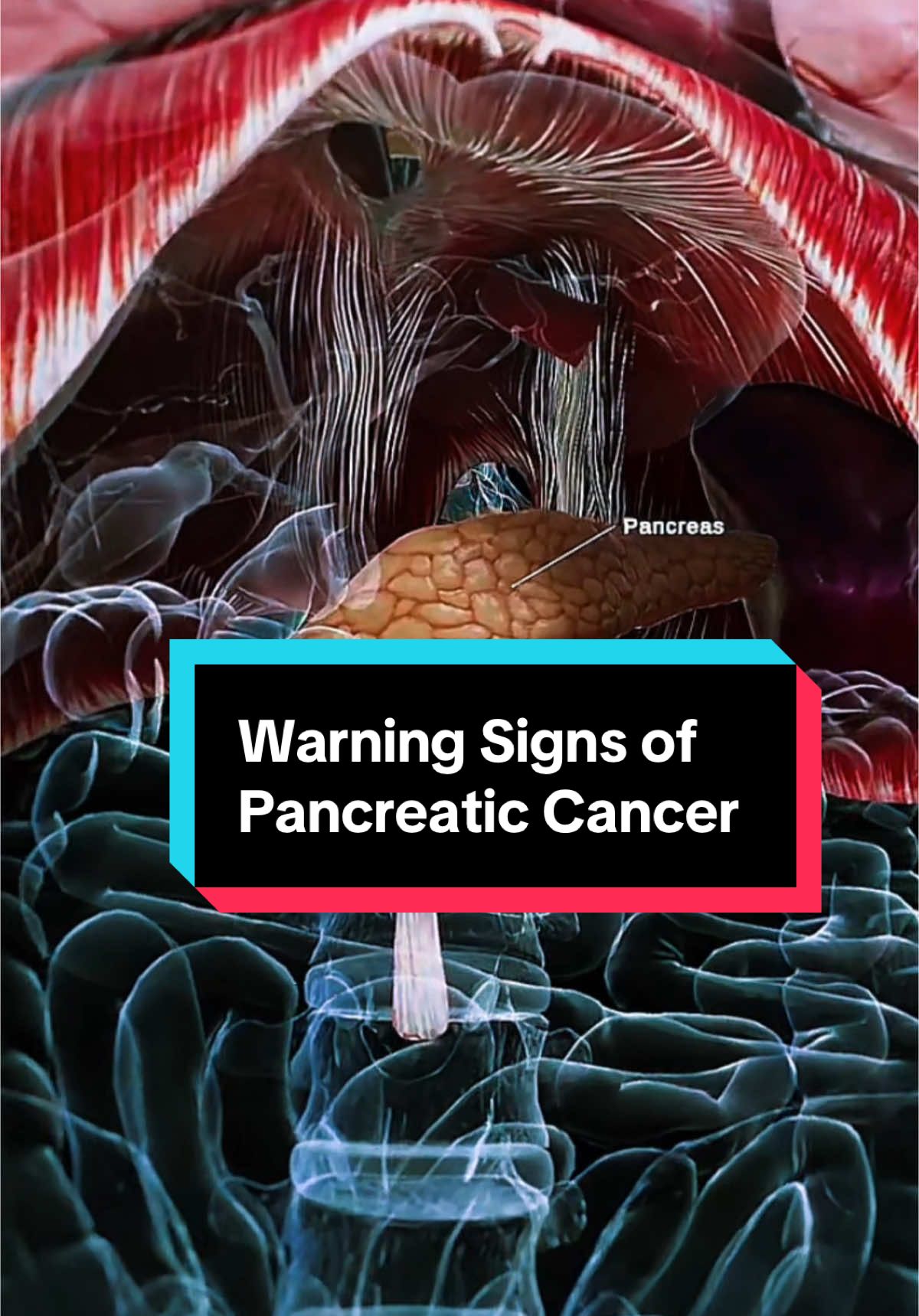 Warning Signs of Pancreatic Cancer  #pancreaticcancer#pancreaticcancerawareness#pancreas#pancreatic 