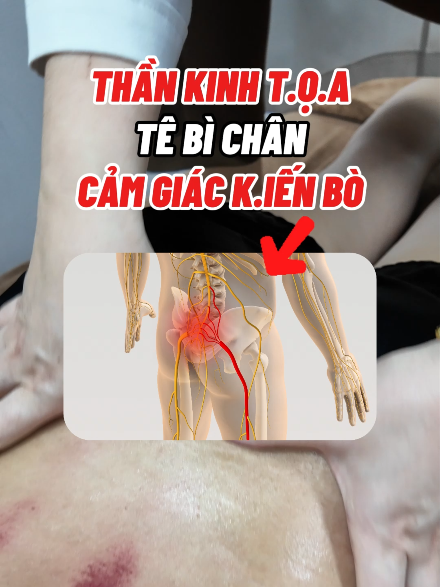 Đ.au thần kinh t.ọ.a, tê bì chân cảm giác như k.iến bò #thankinhtoa #techan #trilieuvientam #suckhoe #xuhuong #capcut #hoangdieptrilieu