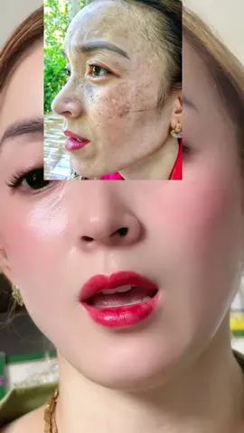 3-5ngày bong tróc rụn sạch tàn nhang k sưng đỏ pp tại nhà cực kỳ đơn giản#Làm đẹp #Mụn#Nám#Tàn nhang#Tái tạo