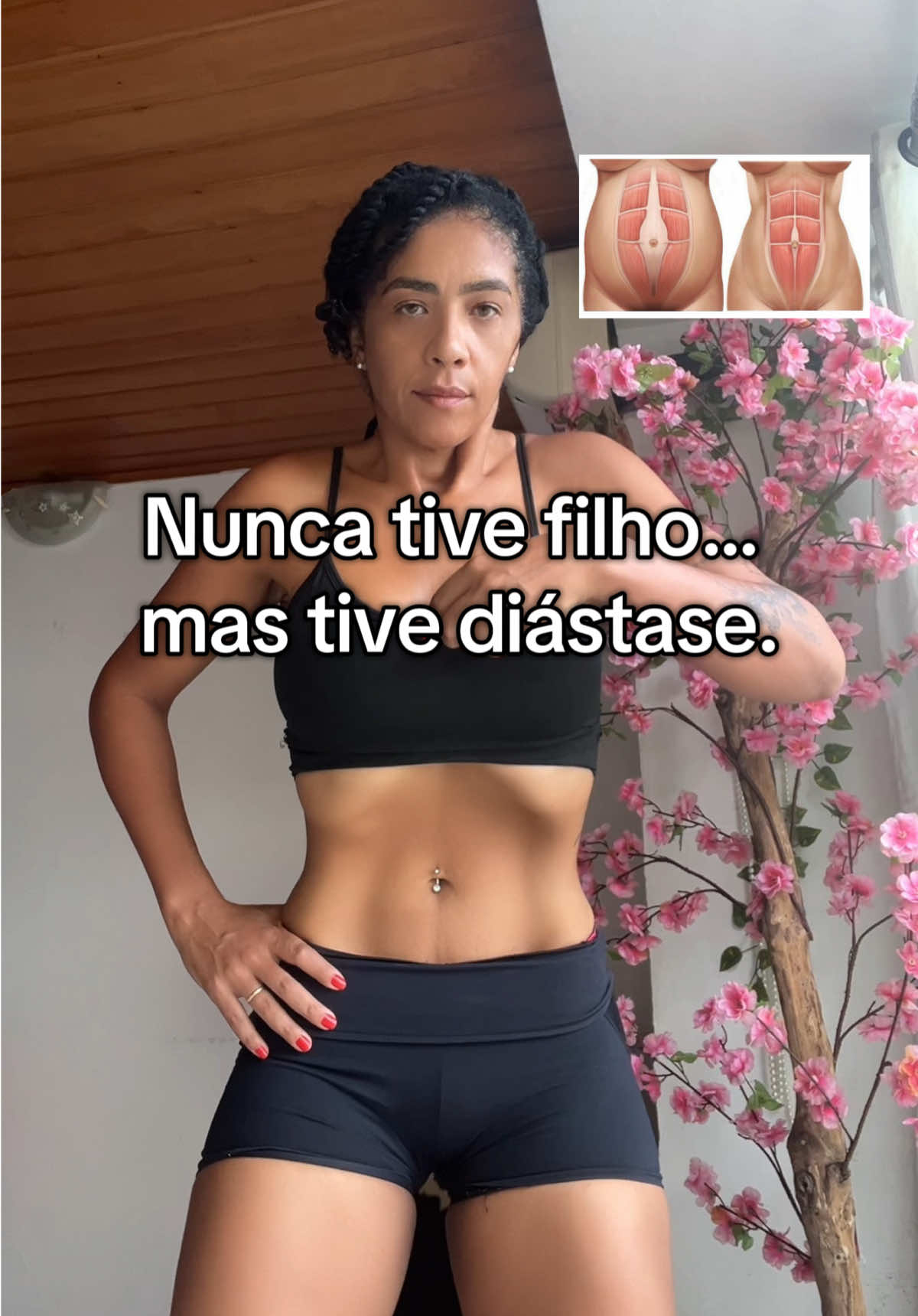Muita gente acha que só quem teve filho pode ter diástase… Mas deixa eu te contar uma coisa: eu nunca engravidei e tive uma diástase de 3cm! A verdade é que a diástase acontece quando os músculos do abdômen se afastam. Na maioria das vezes, sim, isso rola após a gravidez… Mas também pode surgir por treinar errado, fazer muita força abdominal, ou ter o core fraco. Eu mesma descobri depois de sentir minha barriga sempre estufada, mesmo magra. Achava que era inchaço… e era fraqueza profunda no abdômen! Comecei a treinar o core da forma certa — e minha barriga mudou MUITO. Se você sente a barriga meio solta, mole, ou tem dúvida se pode ser diástase, comenta aqui: “me explica mais sobre isso” Que posso trazer um vídeo completo sobre o tema!