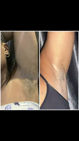 une gamme qui blanchit chaque zone sombre qu'elle touche  aisselles noires solution aisselles noires senegal aisselles noires bicarbonate aisselles noires traitement naturels aisselles noires Summerbody aisselles noires astuces aisselles noires signification  aisselles noires remedes aisselles noires et malodorant aisselles noires et entres jambes noires #hyperpigmentation #darkunderarms #aissellesfoncées #tache #aissellesombre 
