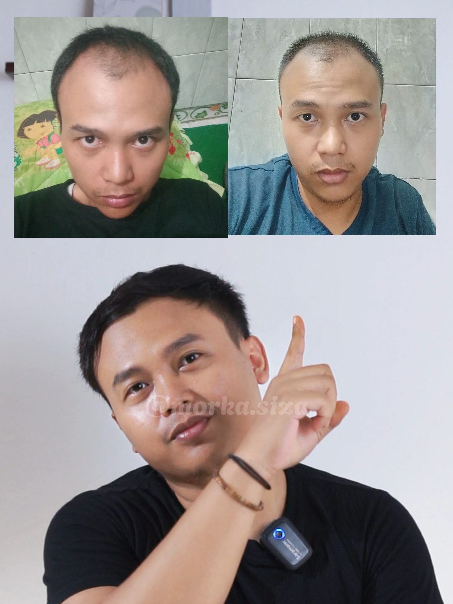 rawat rambutmu sebelum rambut kalian habis #fyp #kebotakan #kebotakandini #rambut #shumijapan #botak