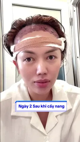 Sáng ngày 2 sau khi cấy tóc của mình. Mình ko phải rửa hay xịt gì cả. 💊 cũng đơn giản lun.##cấytóc #reviewcaytoc #tráncao #hói_đầu #xuhuong