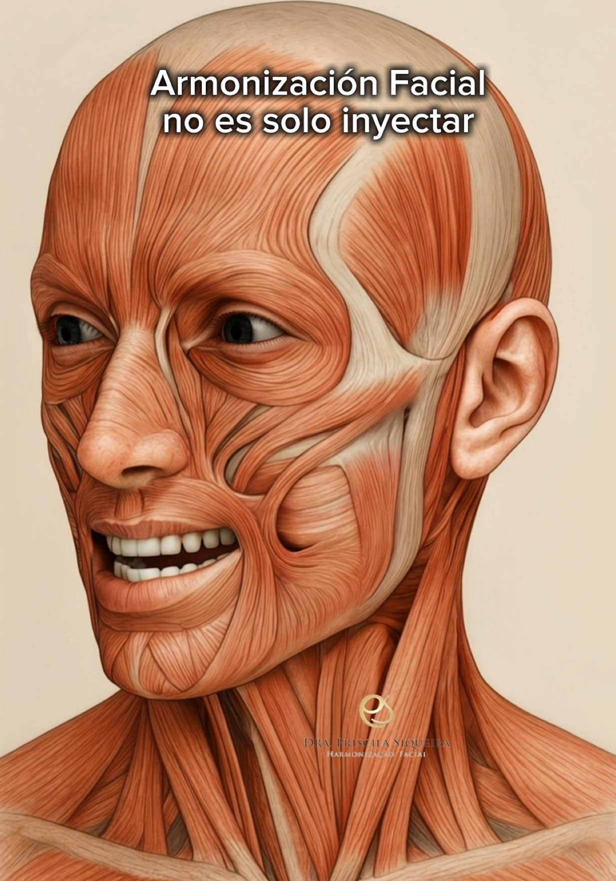 La armonización facial no es solo inyectar: es interpretar la anatomía tridimensional del rostro humano. Una planificación estética verdaderamente eficaz exige mucho más que dominio técnico: requiere una comprensión profunda de la anatomía facial en sus diferentes capas, planos y dinámicas funcionales. Inyectar sin conocer la vascularización, inervación, compartimentos grasos, estructuras óseas y puntos de riesgo equivale a operar sin mapa ni brújula. Cada rostro representa una arquitectura única, en constante transformación con el paso del tiempo. El conocimiento anatómico permite no solo evitar complicaciones —como necrosis, parálisis o migraciones de producto—, sino también diseñar planes personalizados que respeten la morfología, proyección y movilidad del paciente. La arteria facial y sus ramas (como la angular o infraorbitaria), el foramen mentoniano o el ligamento orbitario-malar son referencias que deben guiar cada decisión. Además, los compartimentos grasos superficiales y profundos se comportan de forma distinta con la edad, alterando el soporte y la tensión de los tejidos. Ignorar estas variaciones es perder la oportunidad de tratar causas en lugar de síntomas. Por ejemplo, un surco nasogeniano puede no necesitar relleno directo si la pérdida volumétrica en el compartimento medial o el malar profundo es la causa primaria. La armonización moderna no se basa en “rellenar líneas”, sino en restaurar arquitectura, proyección, sombra y luz. Para lograrlo, el profesional debe tener dominio visual, anatómico y fisiológico. El ácido hialurónico, los bioestimuladores y la toxina botulínica son solo herramientas; el verdadero arte reside en la planificación estratégica basada en ciencia. Por eso, antes de pensar en la aguja o la cánula, es necesario pensar en anatomía. Solo así se logra un resultado seguro, funcional y estéticamente coherente. #armonizacionfacial #medicinaestetica 