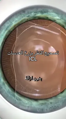 متقدرش تصحّح نظرك بالليزر؟ ضعف النظر مأثر على حياتك؟ الحل الأمثل  والفعّال هو عملية  زرع عدسات ICL! عدسة تنزرع داخل العين وتخليك تشوف بوضوح… بكل راحة ، وبدون نظارات! ‏‎استفيدوا من أفضل التقنيات والابتكارات لعلاج أعينكم في عيادة حموش لطب العيون  ❤️  للمزيد من المعلومات و لحجز موعد تواصلوا معنا على الرقم :  0783672006 ‎استفيدوا من أفضل التقنيات والابتكارات لعلاج أعينكم في عيادة حموش لطب العيون  ❤️  0783672006 ‎‏#h#hamoucheo#ophtalmologiea#algerie‎‏‎#ح#حموشط#طب_العيونا#الجزائرت#تصحيح_النظرالليزز