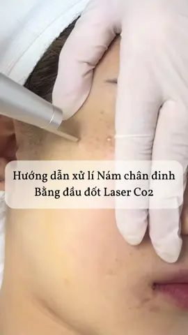 Kĩ thuật xử lí Nám chân đinh #khoá_học_nám_nâng_cao #cobeauty #oanh_trị_nám #trinam #Co2 #laser_co2_trị_nám #tăng_sắc_tố_da #trị_nám_tàn_nhang #peel_nám 