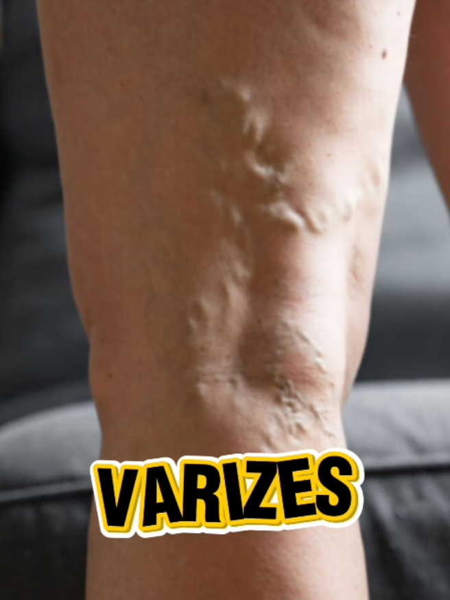 Varizes - Tratamento natural, barato e em casa. Mais de dez anos de resultados. Quer saber como? Link do meu whatsapp na Bio, mande o seu número de WhatsApp com DDD ou mande EU QUERO  #brasil #mulher #mulheres #varizes #beleza #estetica 