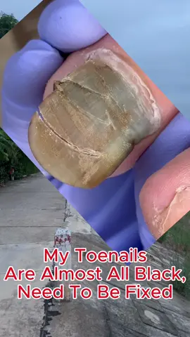 #toenails #toenailremoval #ingrowntoenail #onychomycosis #pedicure #satisfyingvideo #cleaning #asmr #usa🇺🇸 