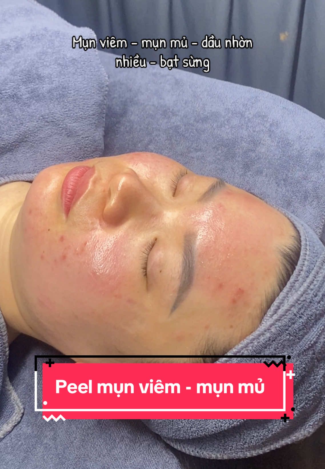 Da mụn viêm mụn m.ủ da dày sừng gặp e này tắt điện #spabacninh #spa #duocmypham #munviem #munmu #munto #mun #trimun #peelmun 