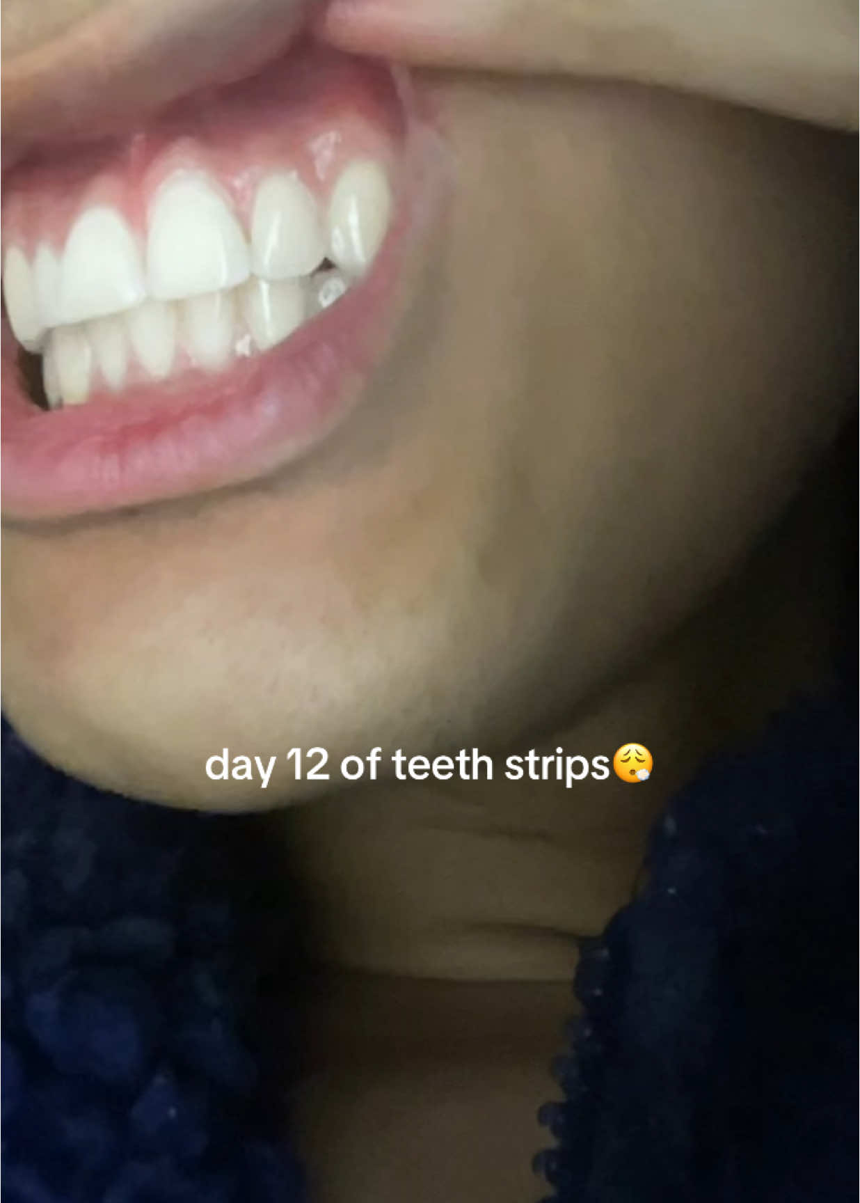^link to where I got mine #teethwhitening #whiteteeth #veneers 