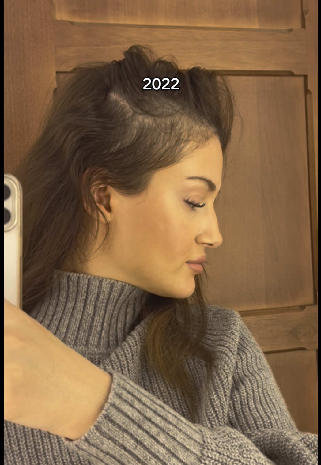 hardest process ever, but it worth it!! #hairloss #hair #fyp #for #u #tik_tok 