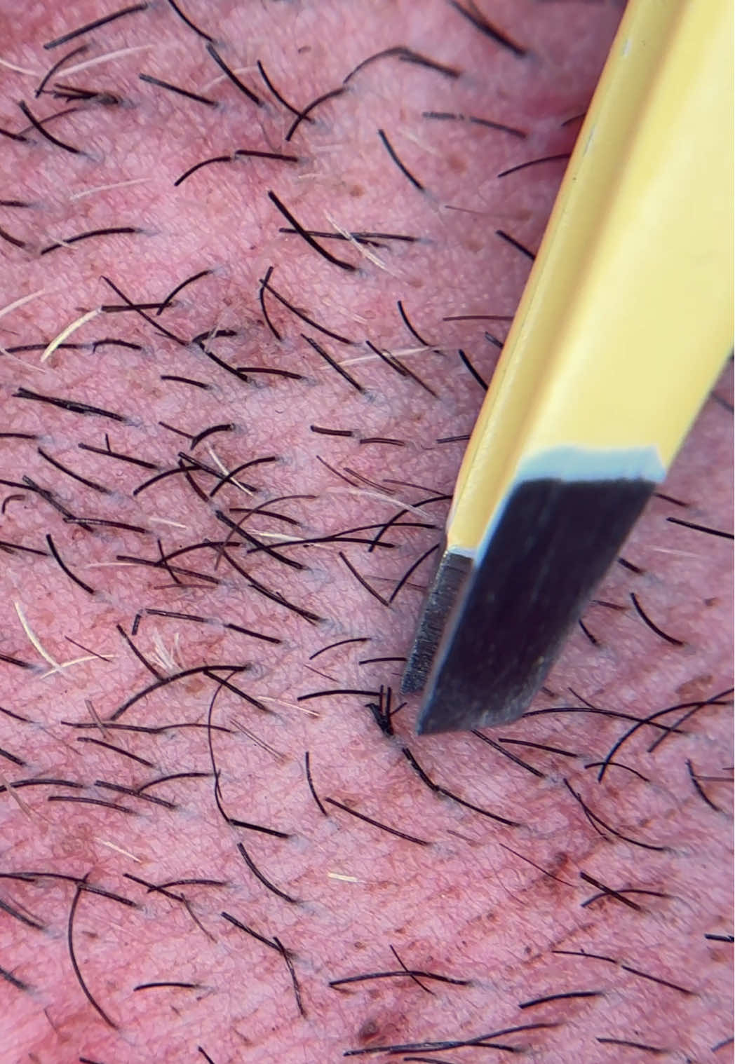 Plucking my boyfriend’s satisfying thick beard hairs  #satisfyingskincare #compoundhair #thickhairpulls #plucking #hairplucking #boyfriendgoals #menwithbeards #trichotillomania #beardhairplucking #beardtok #strangleysatisfying #extractions 