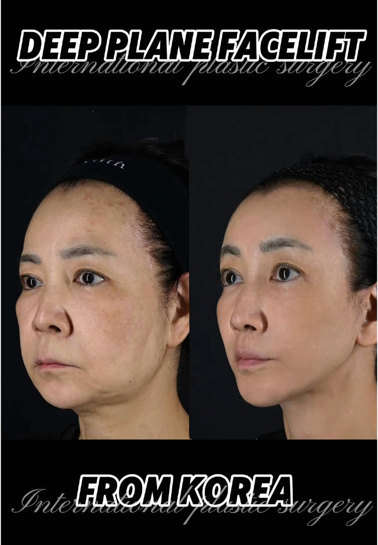 #facelift #facelifting #lowerfacelift #facelifts #agingwell #antiaging #plasticsurgery #deepplanefacelift #جمال #عمليت #عملية #عيادة #عي#عيادة #faceliftbeforeandafter #over60 #lookyoung #lookingyoung #aging 