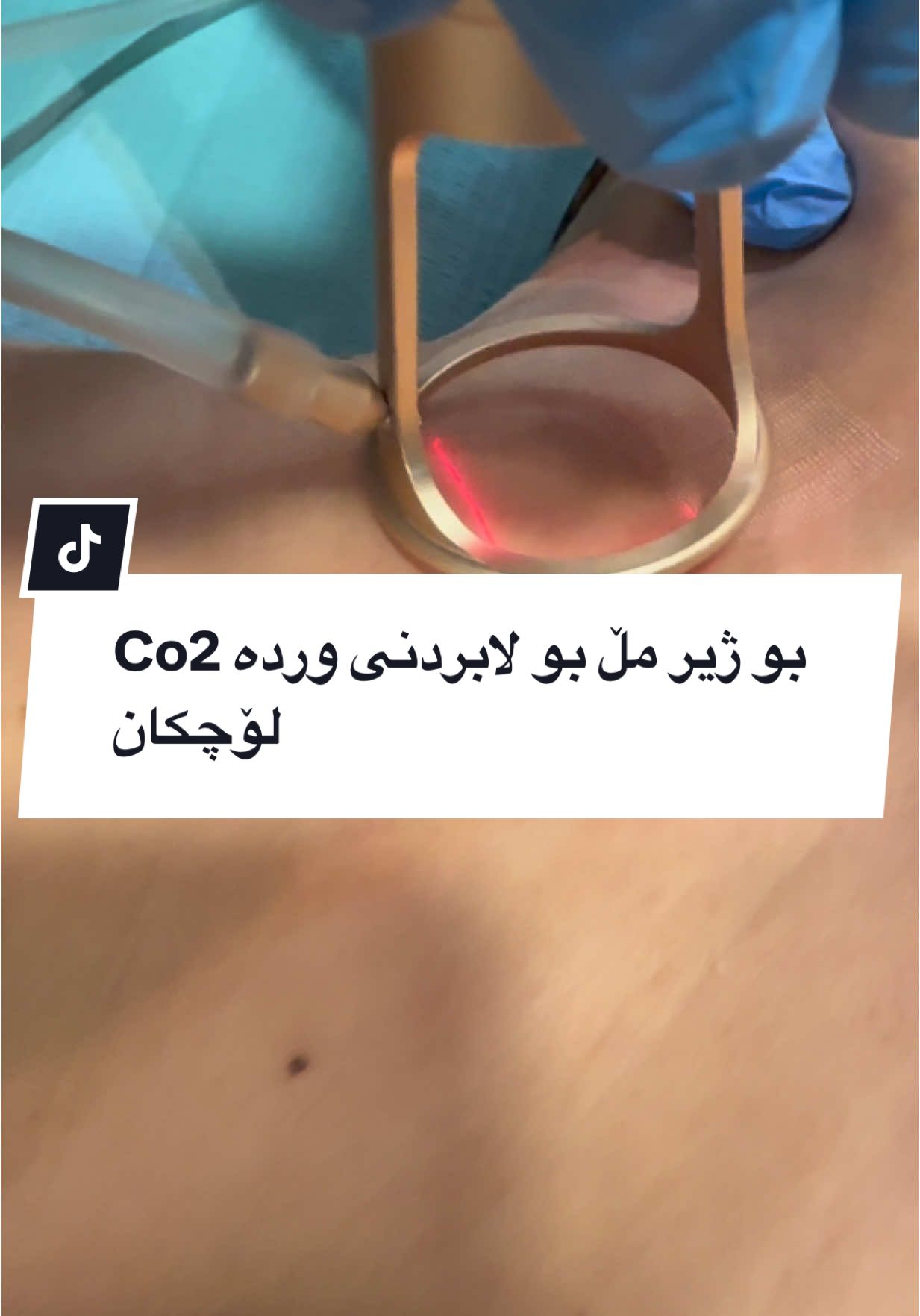 #fyp #tiktokkurd #pakistan #kurdistan #foryoupage❤️❤️ #کردستان #FillerTransformation #BotoxAndFiller #BeforeAndAfter #GlowUp #ViralBeauty #TikTokTrend #BeautyClinic #YoungForever #SkincareGoals #tiktokurdu #uklife🇬🇧 #kurd #kurdish #پاکستان  #london #birmingham #bristol #glosgow #manchesterunited  #liverpool 
