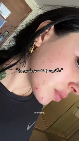 واخيراً راحت الحبوب وبقت بس الآثار ^^ وطبعا احب اذكركم انو لا تنسون تهتمون بالتغذية جدا، حيل حيل تأثر على بشرتنا التغذية. واذا عدكم اسئلة حول سيرم الباكتشويل اكتبها حتى اسوي فيديو لاه بس شرح اكثر. . أسم المنتج : EqqualBerry Bakuchiol Plumping Serum . . #skincare #kbeauty #beforeandafter #acne #acneproneskin #eqqualberry #bakuchiol #fyp #explore #relatable #العراق #المغرب🇲🇦تونس🇹🇳الجزائر🇩🇿 #السعودية 