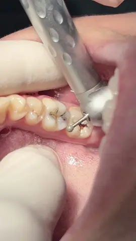 Molar teeth composite restoration #dentist #dental #dentistry #طبيب_اسنان 