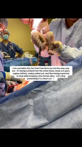 c-section mama x3 💪 and yes that is my baby being cut out of me.  #csection #csectiondelivery #csectionrecovery #csectionmama #csections #normalize #pregnancytiktok #fyp #fypシ #viral #foryoupage #foryourpage #pregnant 